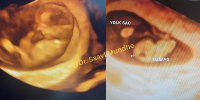 early-pregnancy