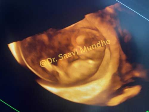 Early Pregnancy Scan