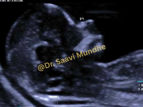 First Trimester Screening