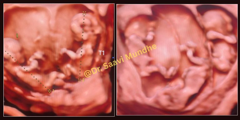 multiple-pregnancies-scan